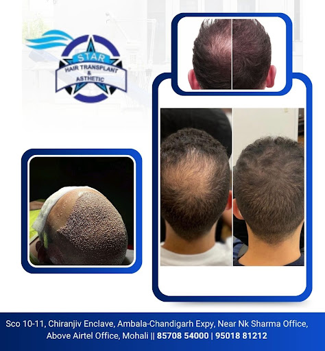 Star hair transplant - Best hair transplant clinic in zirakpur who provides best services for hai… post image