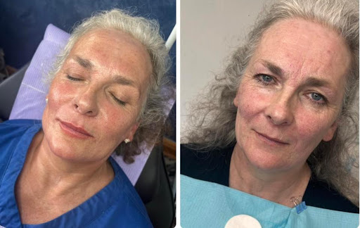 The Ocean Clinic Skegness - Botox - Fillers - Acne - Laser Hair & Tattoo Removal