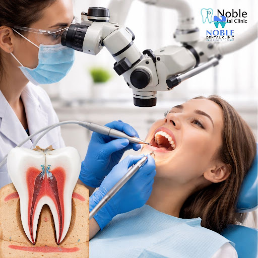 Worried that a root canal will be painful? At Noble Dental Clinic in Saki Naka, Mumbai, we use mo… post image