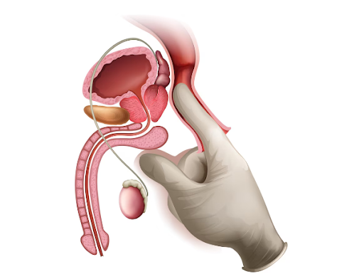 Transurethral Resection of the Prostate (TURP) is a surgical procedure commonly used to treat uri… post image