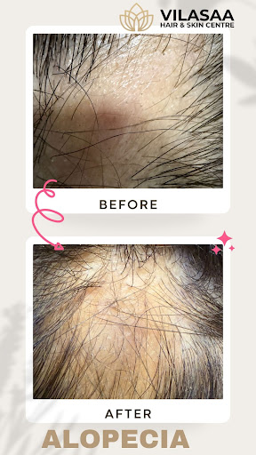 ✨ Alopecia Improvement in Just 1 Session at Vilasaa Hair & Skin Centre! ✨