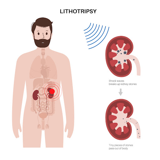 Lithotripsy is a non-invasive procedure used to break down kidney stones into smaller fragments,… post image