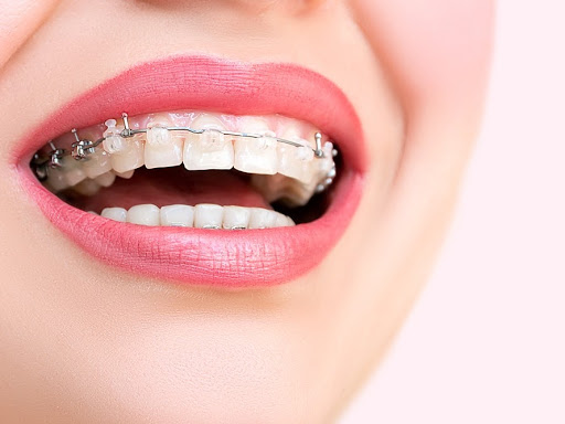 Self-ligating braces come either in traditional metal, ceramic, or clear brackets, and are made f…