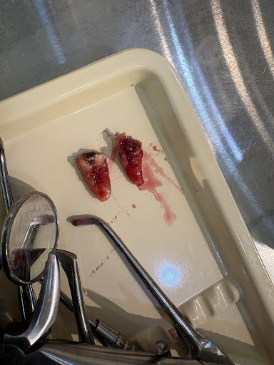 get painless tooth extraction at shanti dental healthcare centre neemrana eldecohillside post image
