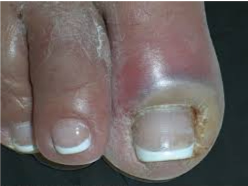 Best Acute Paronychia Treatment in Jaipur

Acute paronychia 