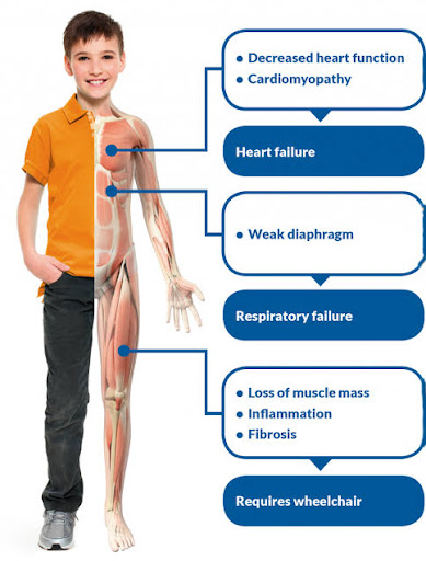 These are group of genetic disorders that causes muscle loss and weakness. Mostly it starts in ch…