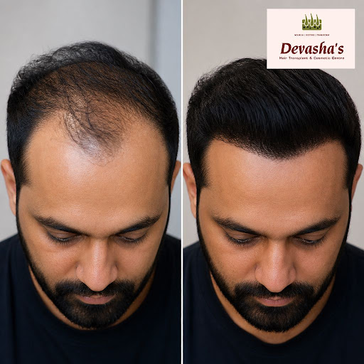 A receding hairline can affect your confidence, but modern hair grafting offers a permanent, natu… post image