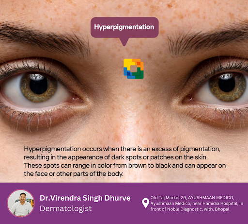 Hyperpigmentation is a common skin condition characterized by dark patches caused by excess melan…