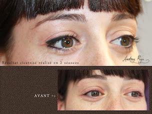 Photo n°16 de Audrey Rojo Dermopigmentation réparatrice à Lavaur (Service de détatouage)