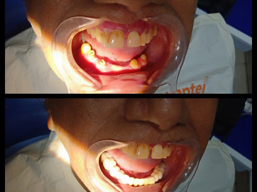 Full mouth rehab...... post image