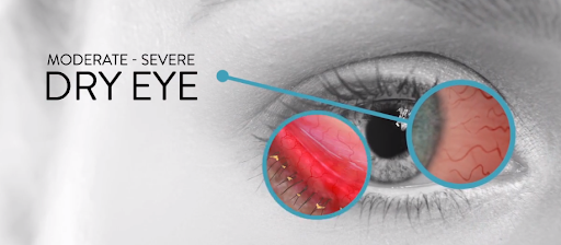 Dry eye is a common condition that occurs when your eyes don't produce enough tears or when the t… post image