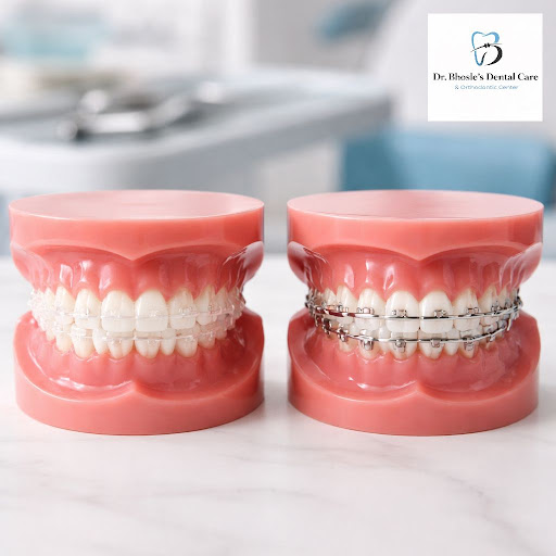 Confused between ceramic and metal braces? At Dr Bhosle's Dental Care and Orthodontic Center Clin… post image