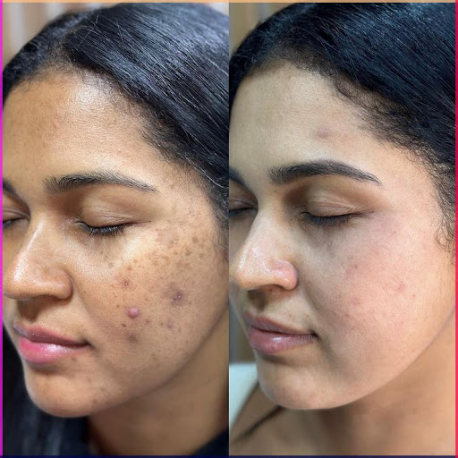 Best Cosmetologist In Mansarovar

#LUMINASKIN&AESTHETICCLINI