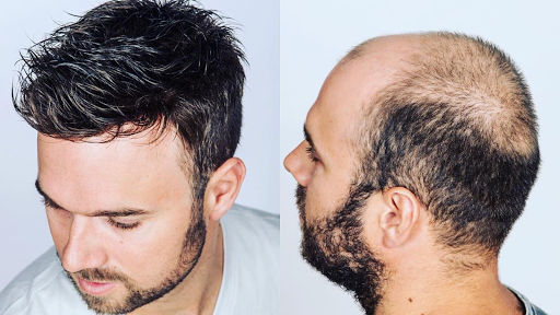 Man Hair - Hair Replacement Solutions - United States