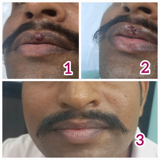 “Scarless healing is possible — even on delicate areas like the lips! With precise technique and… post image