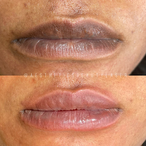 Aesthetics Beauty Laser