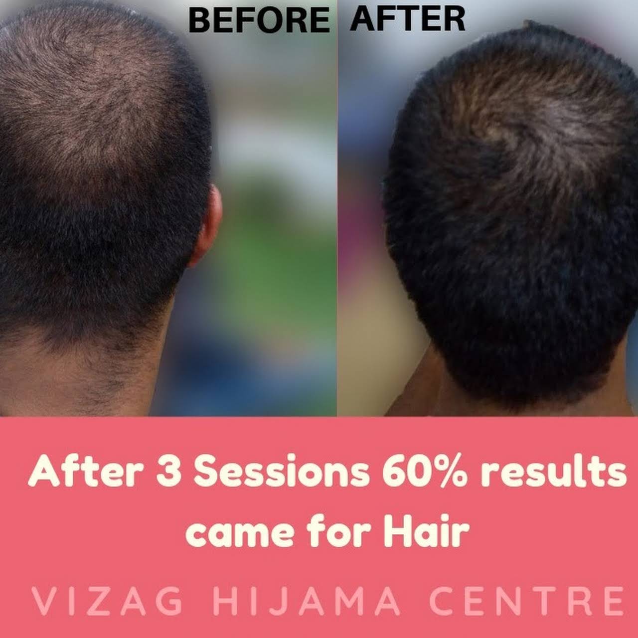 Vizag Hijama Centre (Cupping , Acupressure , Electro Acupuncture , ‚Leech  ,Sujok ‚Moxibustion & IASTM therapy)