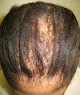Hair transplant clinic Carolina Hair Restoration Center in North Charleston