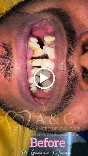 ✨ Natural-Looking Smile with Aesthetic Zirconia Crowns ✨ post image