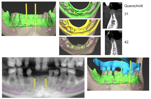 implant oris - Thumbnail