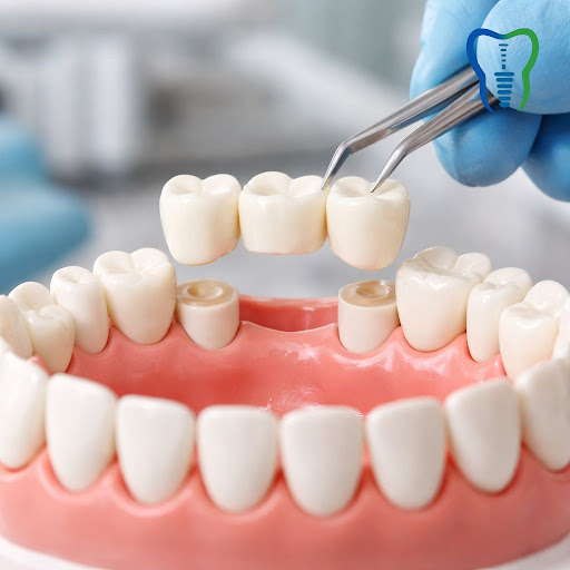 Missing teeth can affect your smile, chewing, and confidence. At Denttofitt in Nashik, our experi… post image