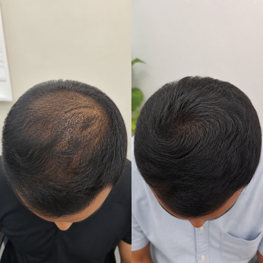 Struggling with hair thinning or hair fall and not seeing real improvement? At Spark the Skin Hai…