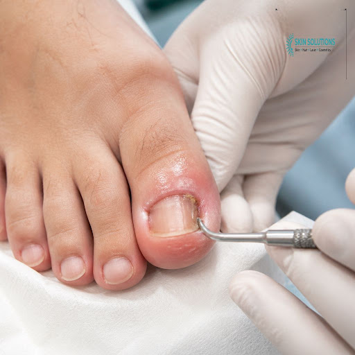 Struggling with painful, ingrown or infected nails that just won’t heal? At Skin Solutions in Swa… post image