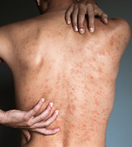 Struggling with itchy skin rashes, redness, or allergies? Ge