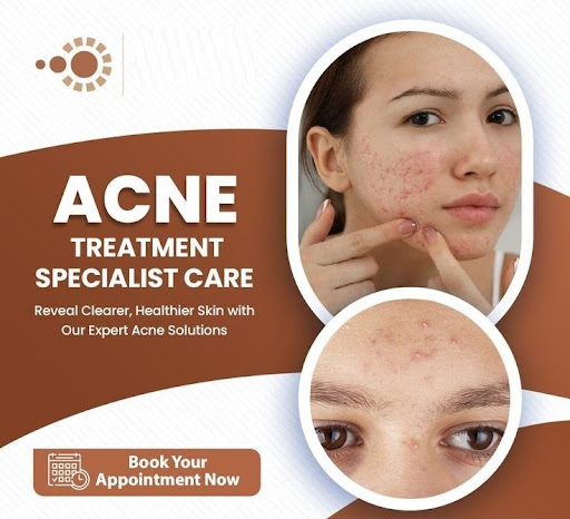 ⭐ Acne Treatment Specialist Care – Reveal Clearer, Healthier Skin! post image