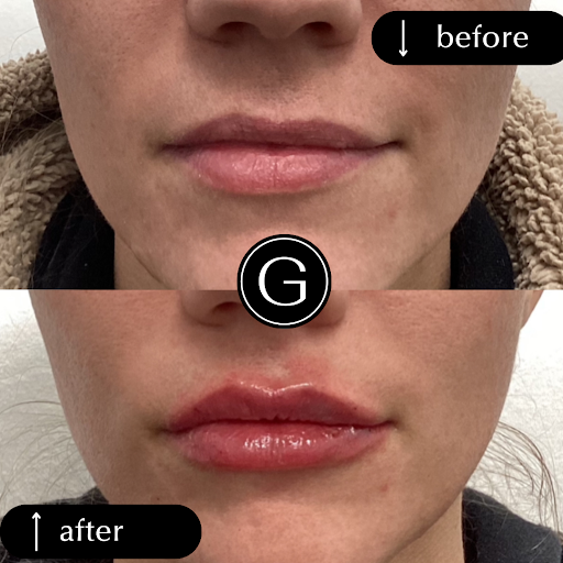 Denver Botox: GATTONI Medical Aesthetics