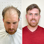 Hair transplant clinic Allusions in Cincinnati