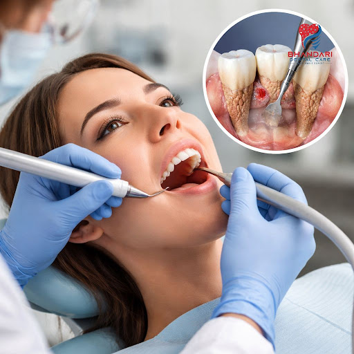 Healthy gums are the foundation of a beautiful smile. At Bhandari Dental Care in Sarkanda, Bilasp… post image