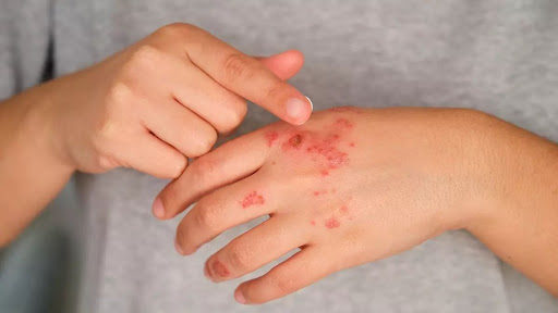 Suffering from skin rashes, eczema, itching, or allergic ski