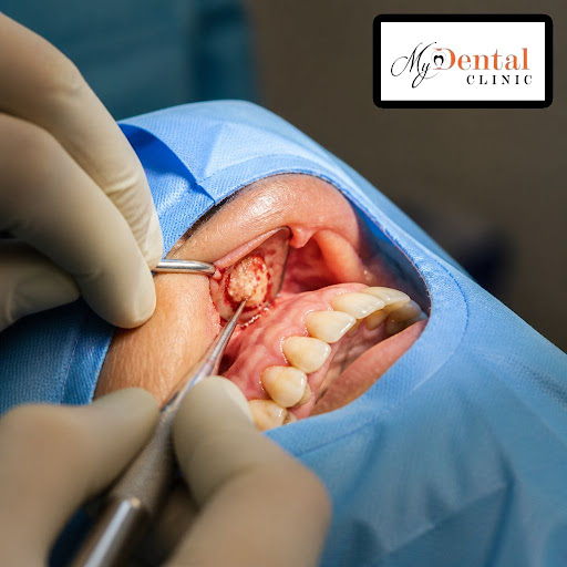 Worried that an infected tooth might need to be removed? At My Dental Clinic - Dr. Neha Chintawar… post image