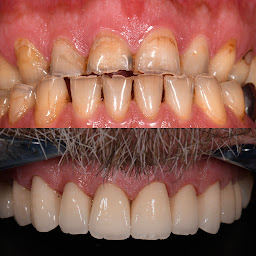 Photo n°14 de Dr Levy Michael ,chirurgien-dentiste implantologiste: implants dentaires ,couronnes- onlay, soins sous microscope à Paris (Dentiste cosmétique)