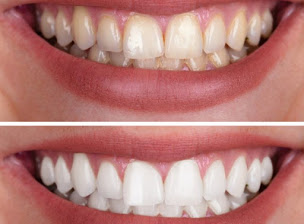 Photo n°1 de Studio beauté / Glowup-gautier à Marignane (Service de blanchiment des dents)