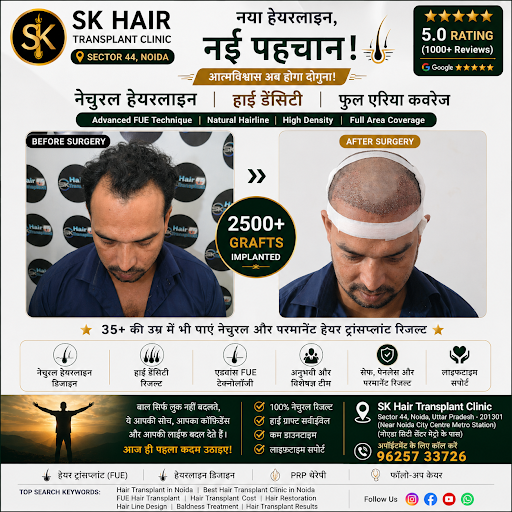 SK Hair Transplant Clinic, based in Sector 44, Noida NCR, provides inexpensive and effective hair… post image