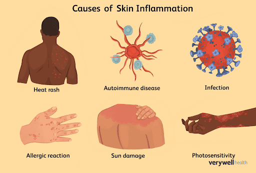 🌿Ayurveda, the ancient Indian system of medicine, offers holistic remedies for managing inflammat… post image