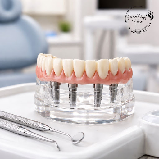 Missing multiple teeth and tired of loose dentures? All-on-4 implant solutions at Hazel Dental Se… post image