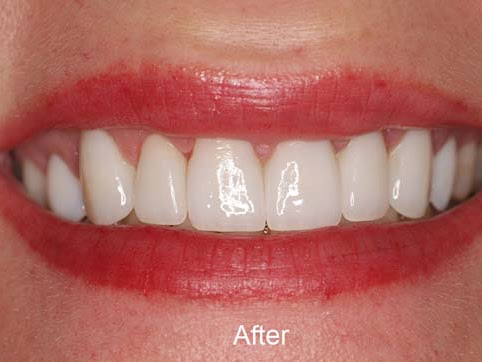 Smile Makeovers correct the patient's dental problems