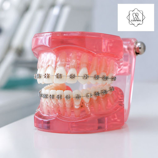 Dreaming of a confident, straight smile without bulky metal braces? At Cuspids Dental Clinic in B… post image