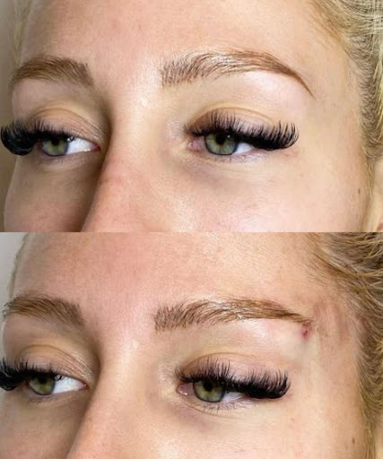 Brows Fillers Harrogate Medical Aesthetics - Thumbnail