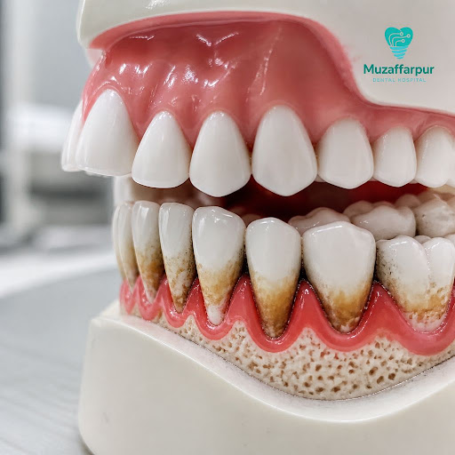 Gums bleeding while brushing, bad breath that doesn’t go away, or shaky teeth are not normal sign… post image