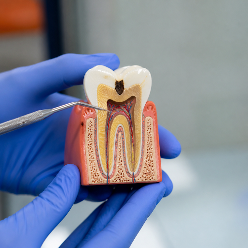 If tooth pain is making it hard to eat or sleep, root canal therapy at Dewangan dental clinic in… post image
