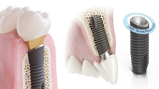 Oral Maxillofacial & Implant Clinic (OMIC) Dr Ng Chee Hon - Thumbnail