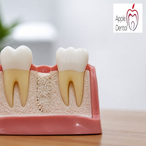 Removing a tooth is sometimes necessary, but losing bone in that area doesn’t have to be. At Appl… post image