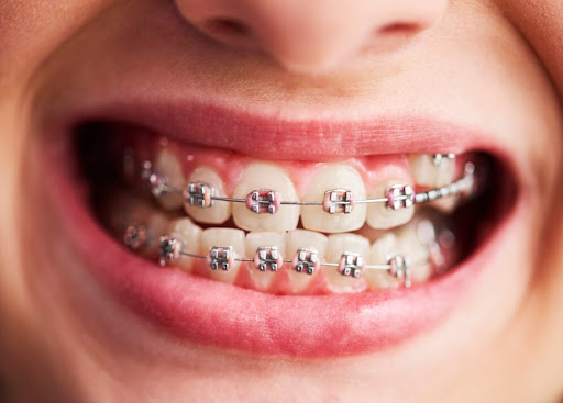 Braces and Invisalign are effective orthodontic solutions used to correct misaligned teeth, spaci…