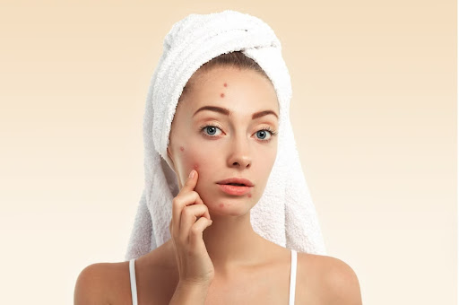 Are you struggling with persistent acne? At Regenesis Skin Clinic, the best skin clinic, we offer…
