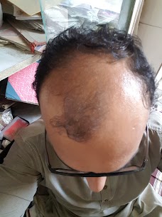 Hair Club Hair Transplant Karachi