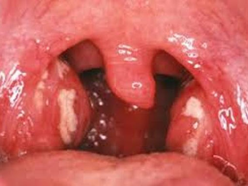 TONSIL post image